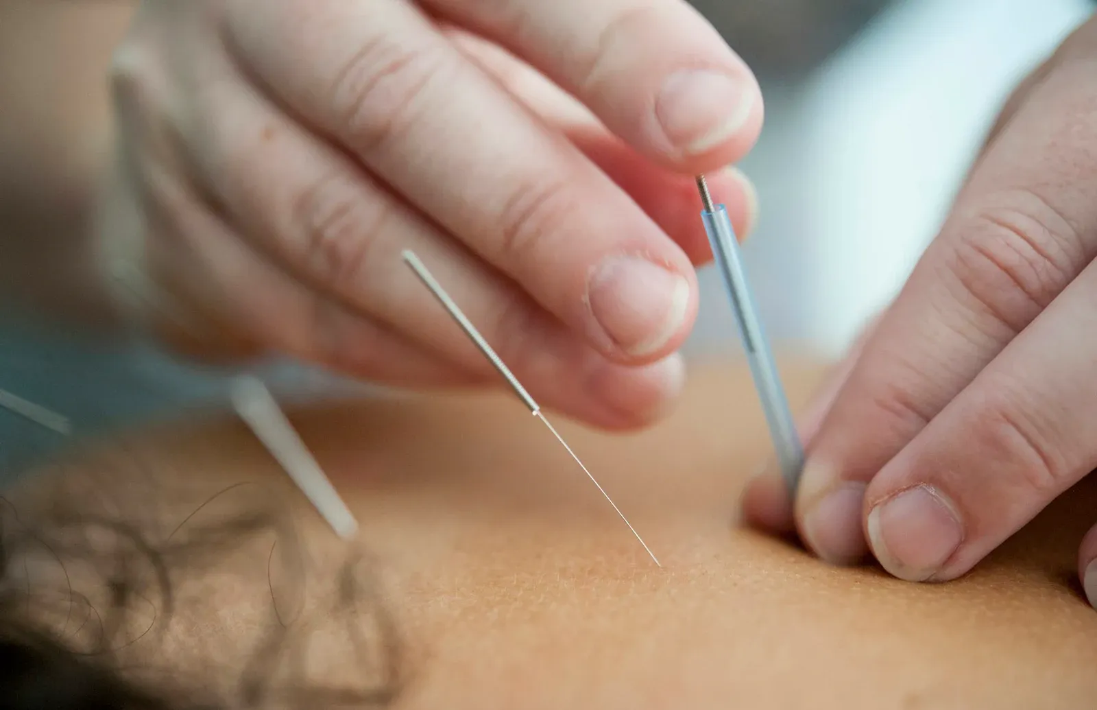 Close das mãos de uma profissional colocando agulhas finas de acupuntura na pele